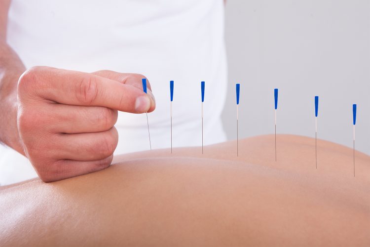 How Does Acupuncture Work for Pain Relief and Healing?