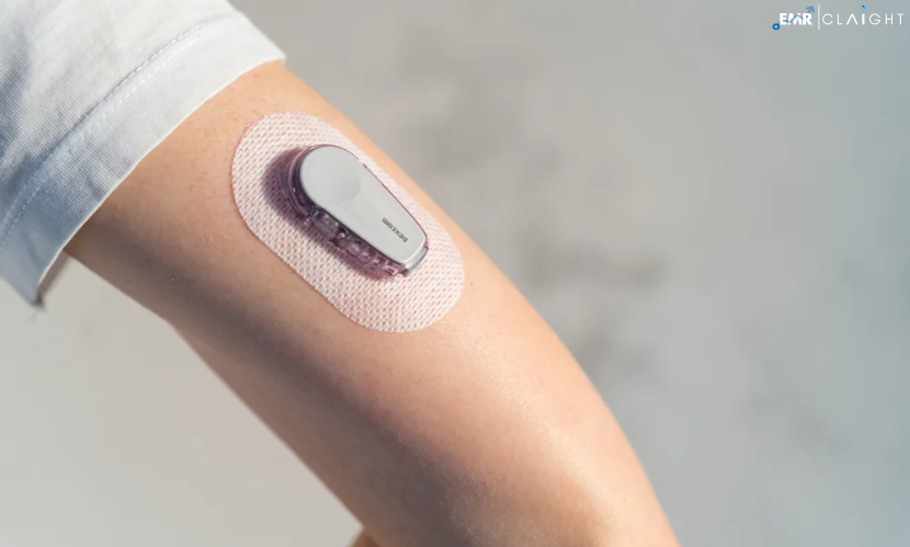 North America Continuous Glucose Monitoring Market