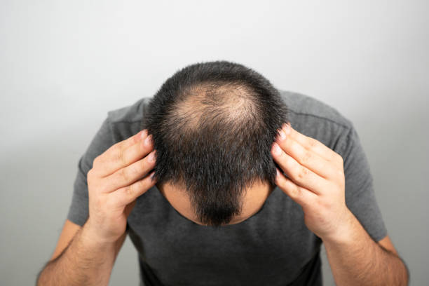 Hair transplant results in Karachi