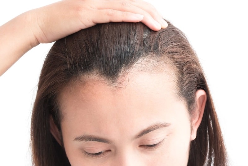 Big Forehead: Can a Hair Transplant Help?