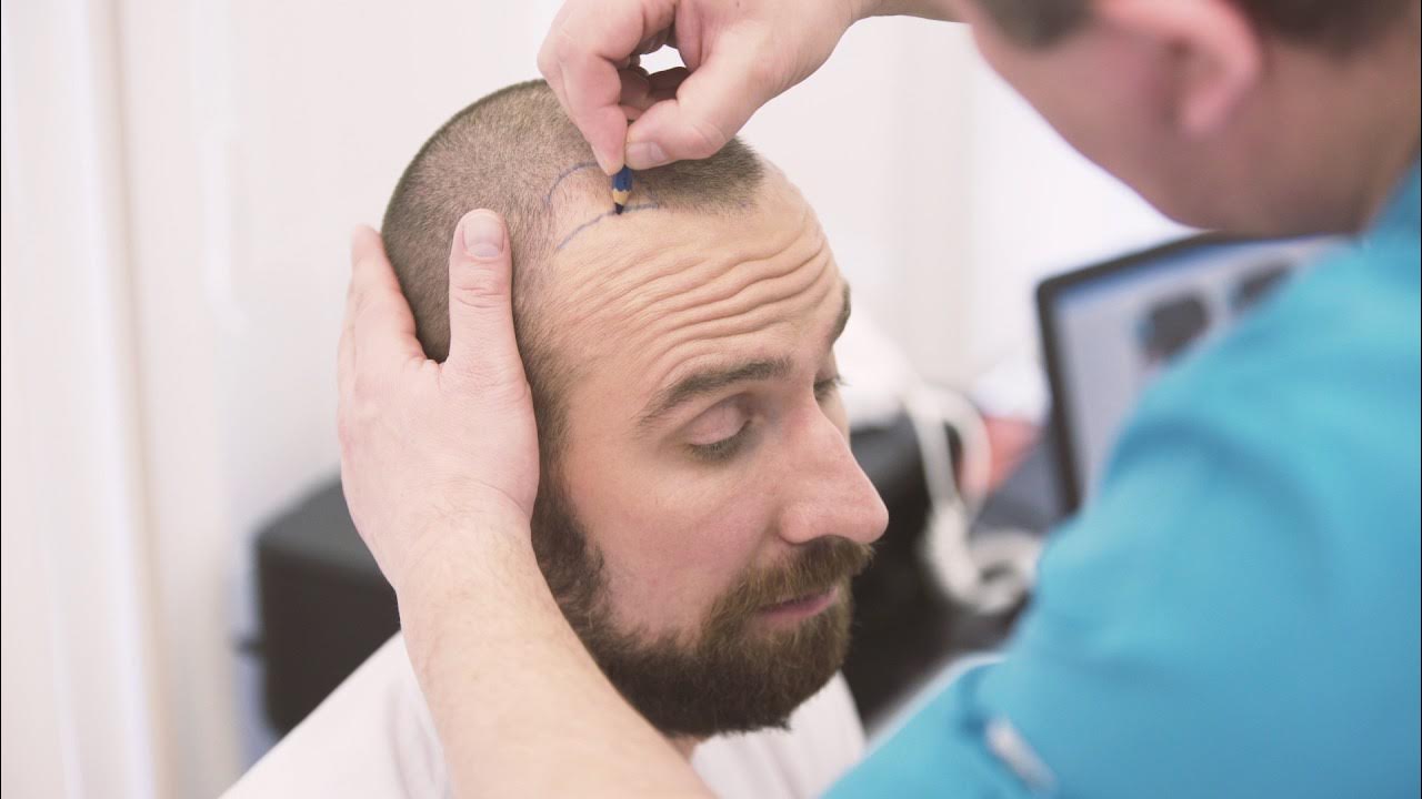 Hair transplant in Dubai