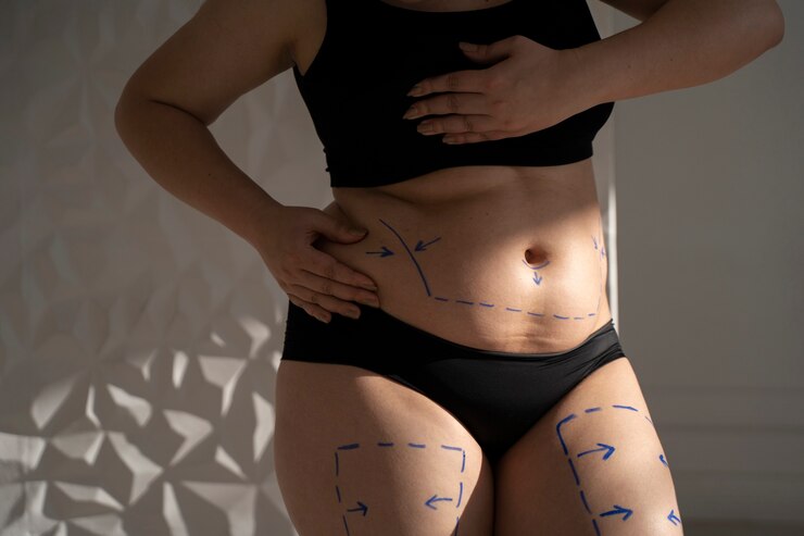 Tummy Tuck in Dubai