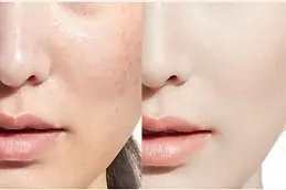 skin whitening treatment in dubai