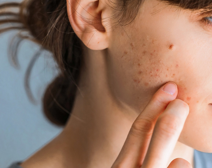 Acne Treatment Dubai