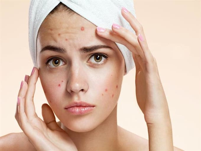Acne Treatment Dubai