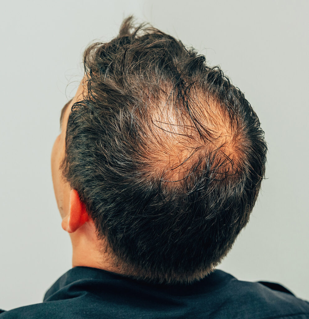 Does Genetics Matter in Hair Loss Treatments