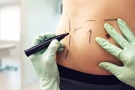 FAT REMOVAL TREATMENT Islamabad