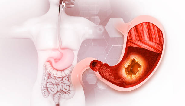 Gastric Balloon in Riyadh