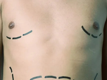 Gynecomastia Surgery in Riyadh