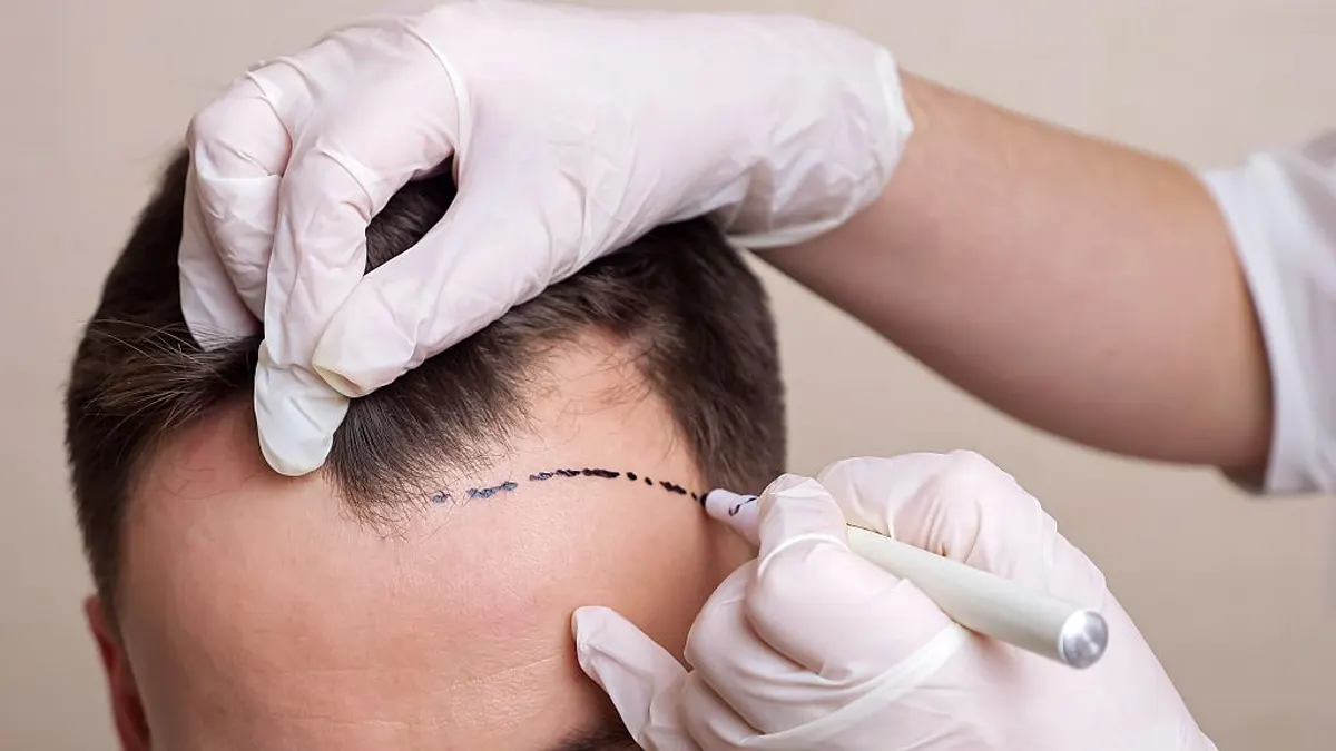 Hair Transplant in Dubai