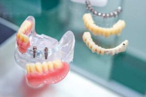 invisalign 