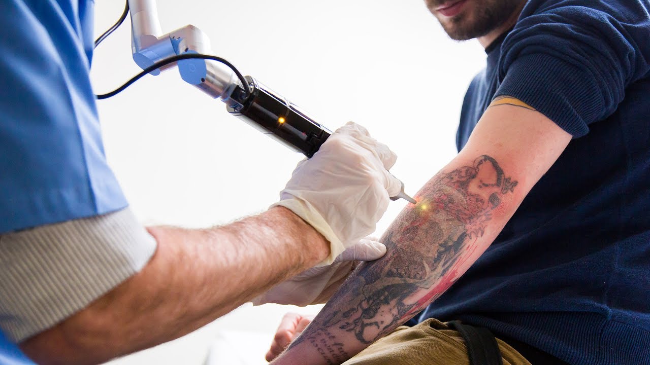Laser Tattoo Removal in Dubai