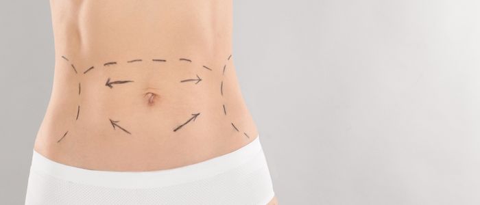 Tummy Tuck in Dubai