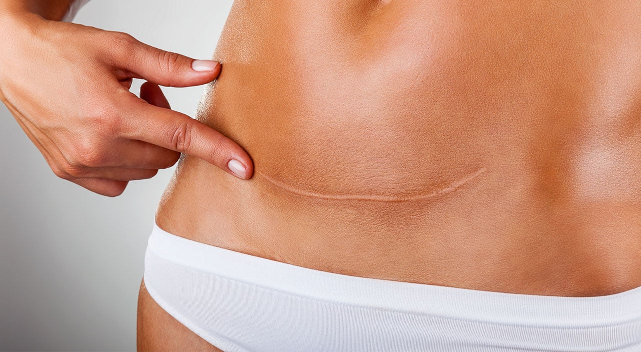 Tummy Tuck in Dubai