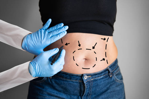 Obesity Surgery in riyadh