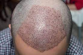 hair transplant in dubai