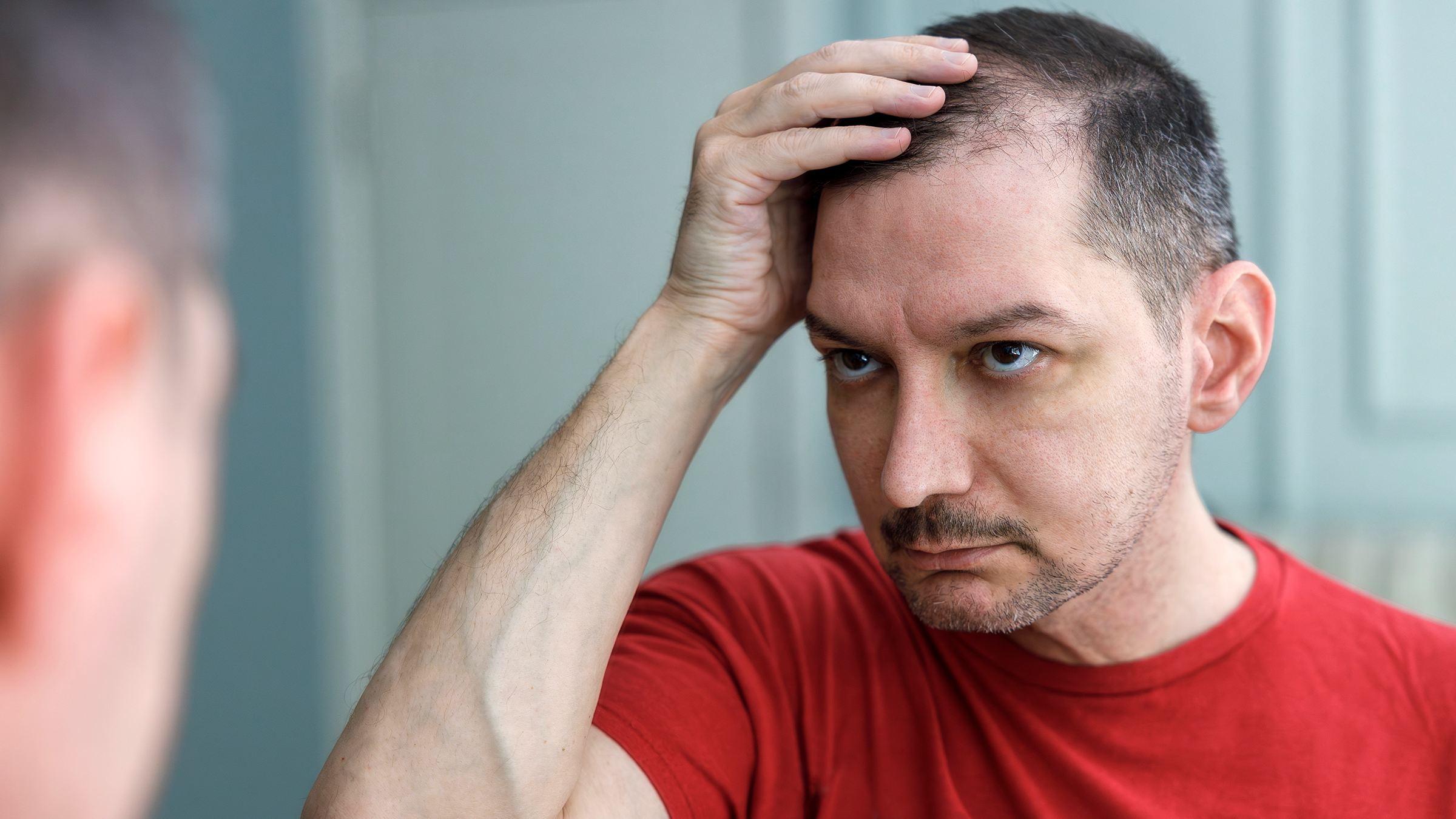 Crown Hair Transplant in Dubai