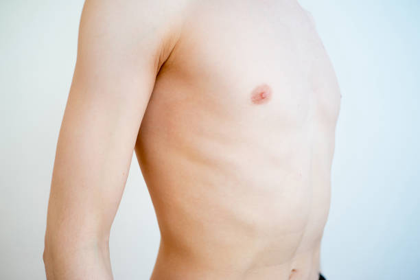 Gynecomastia Surgery in Riyadh