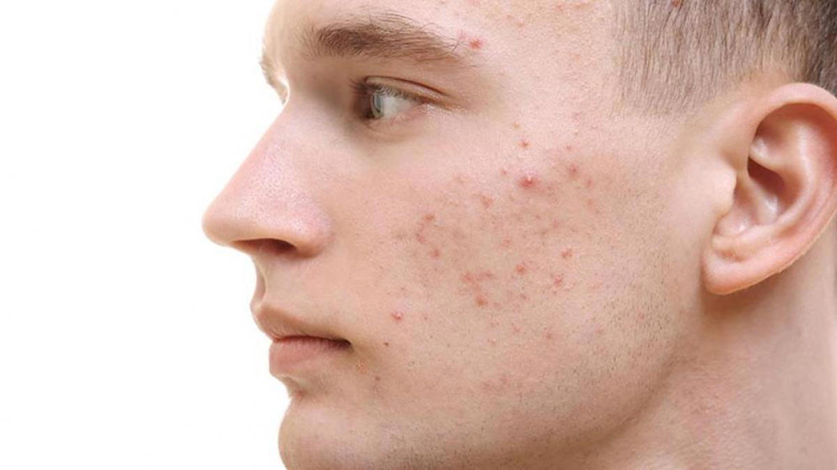 Acne Treatment in Dubai
