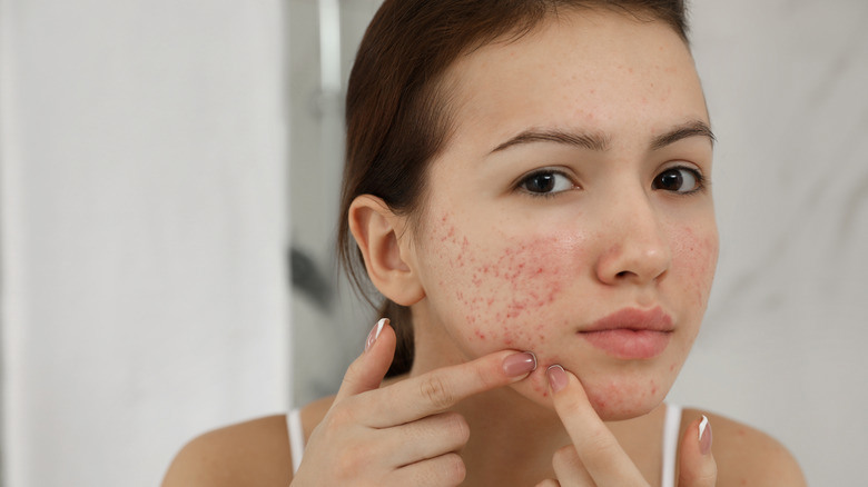 Acne Treatment in Dubai