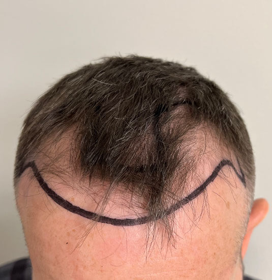 Can You Wear a Hat After a Hair Transplant