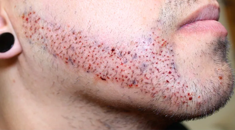 Do Hair Transplants Work for Beards Too?