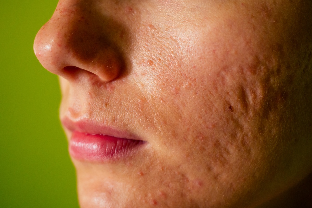 Does Acne Scar Treatment Work on All Scar Types