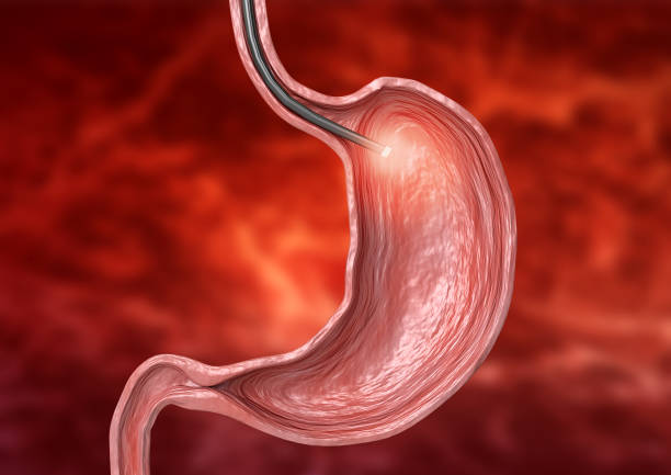 Gastric Balloon in Riyadh