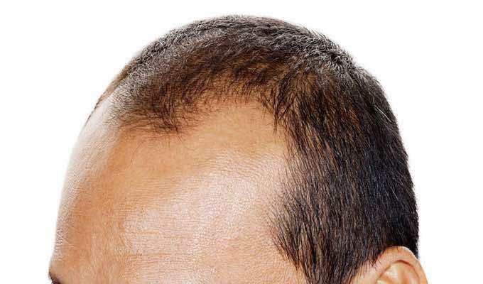 Hair Loss Treatement