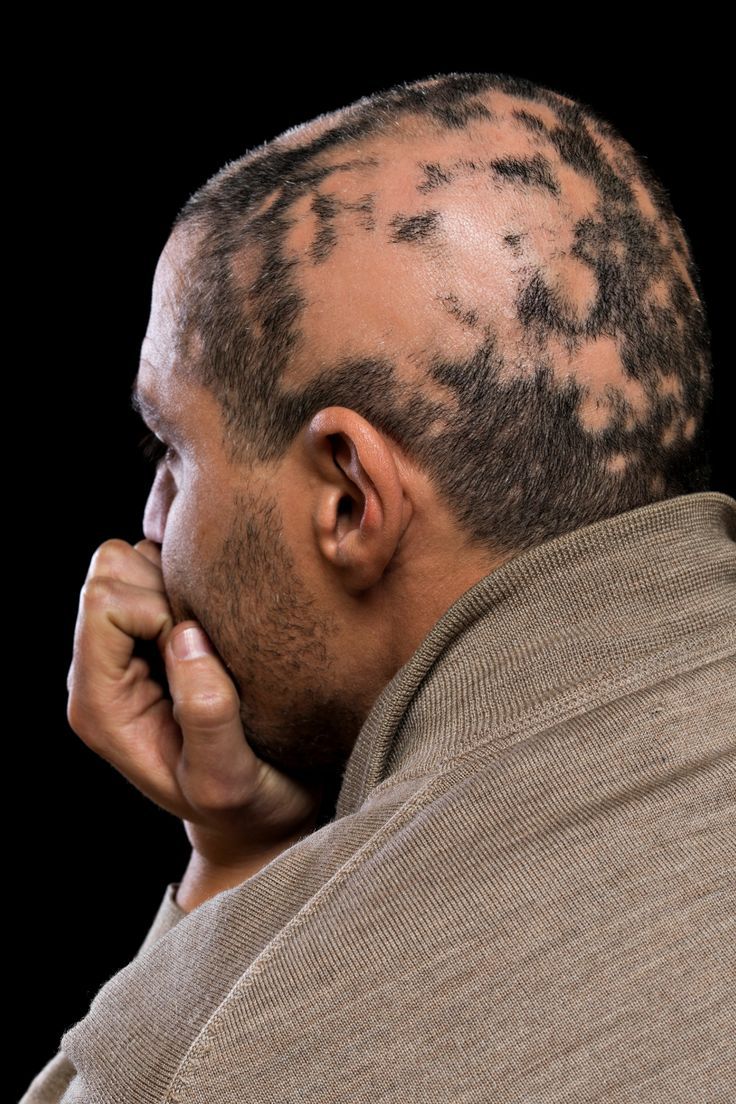 Hair Loss Treatement