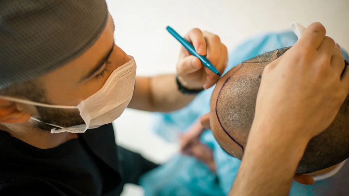 Is Hair Transplant Effective for All Hair Types