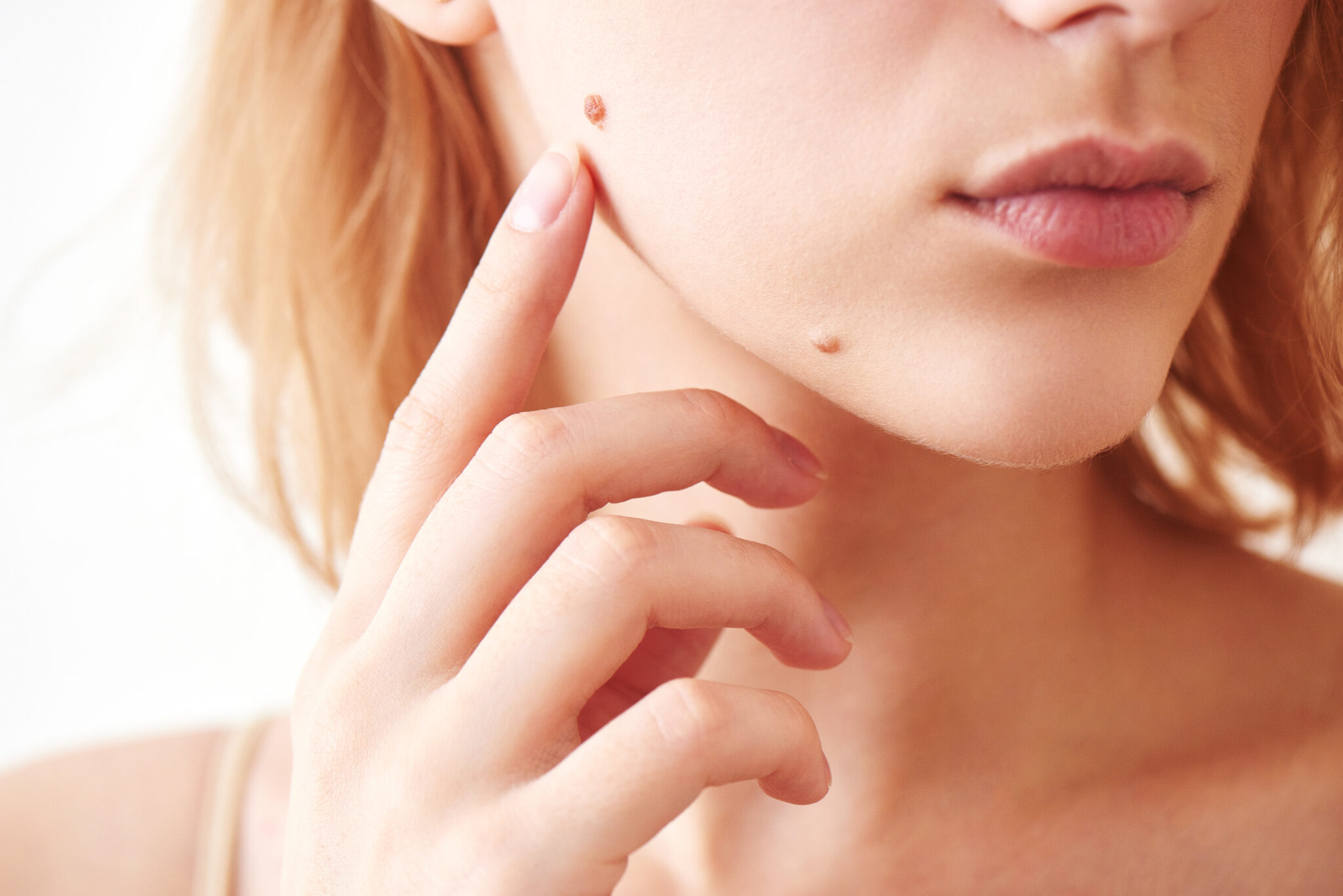 Is Mole Removal a Permanent Solution?