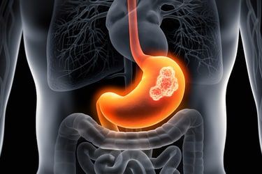 Obesity Surgery in Riyadh