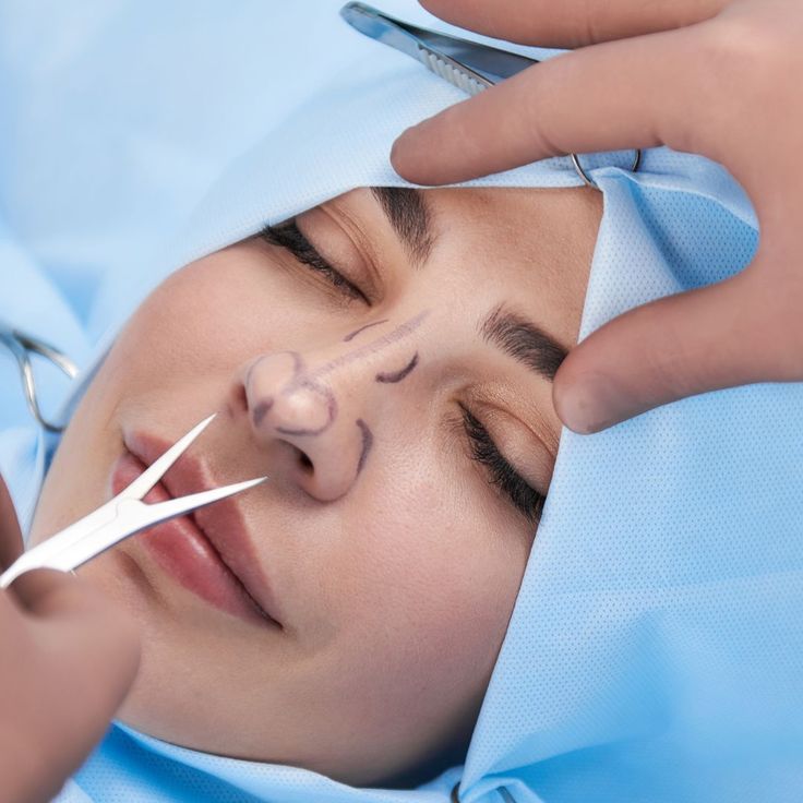 Rhinoplasty Surgery in Riyadh