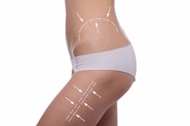 Thigh Lift in Riyadh