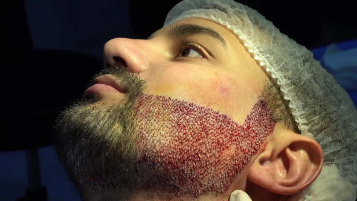 What Makes a Beard Hair Transplant Look Real