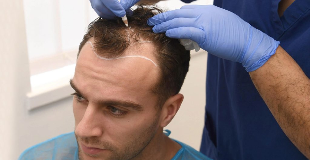 Hair Transplant in Dubai