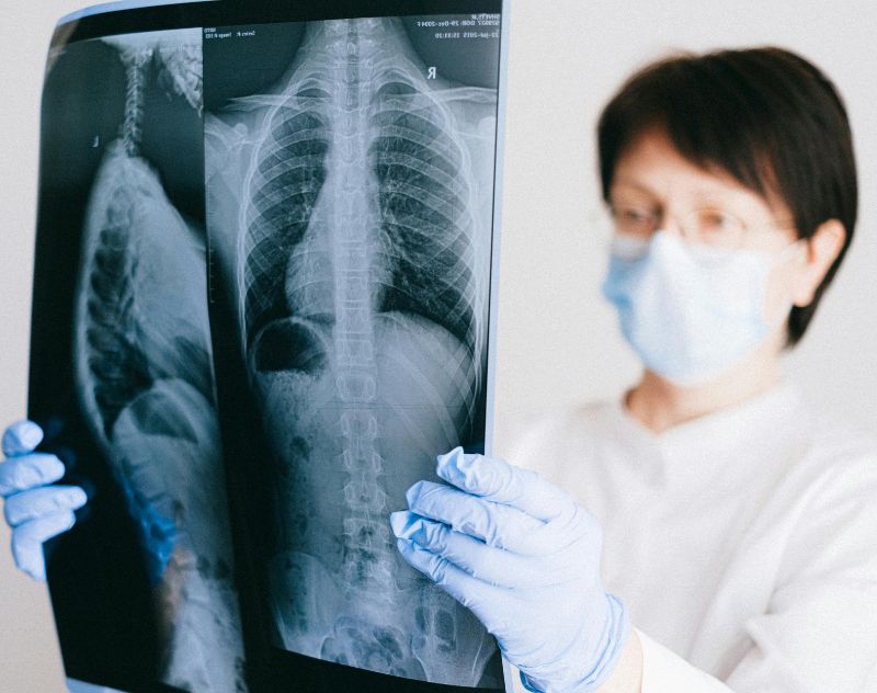 Symptoms Lung Cancer Stages
