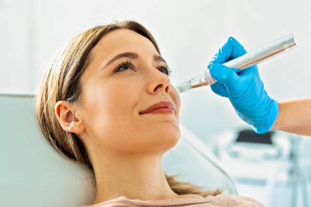 Dermapen in Riyadh for Scars