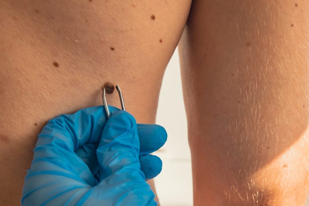 Do Skin Tags Grow In Private Body Areas