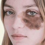 Does Birthmark Removal Lighten Skin?