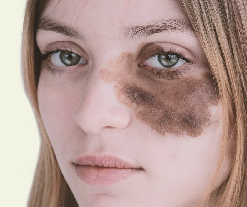 Does Birthmark Removal Lighten Skin?