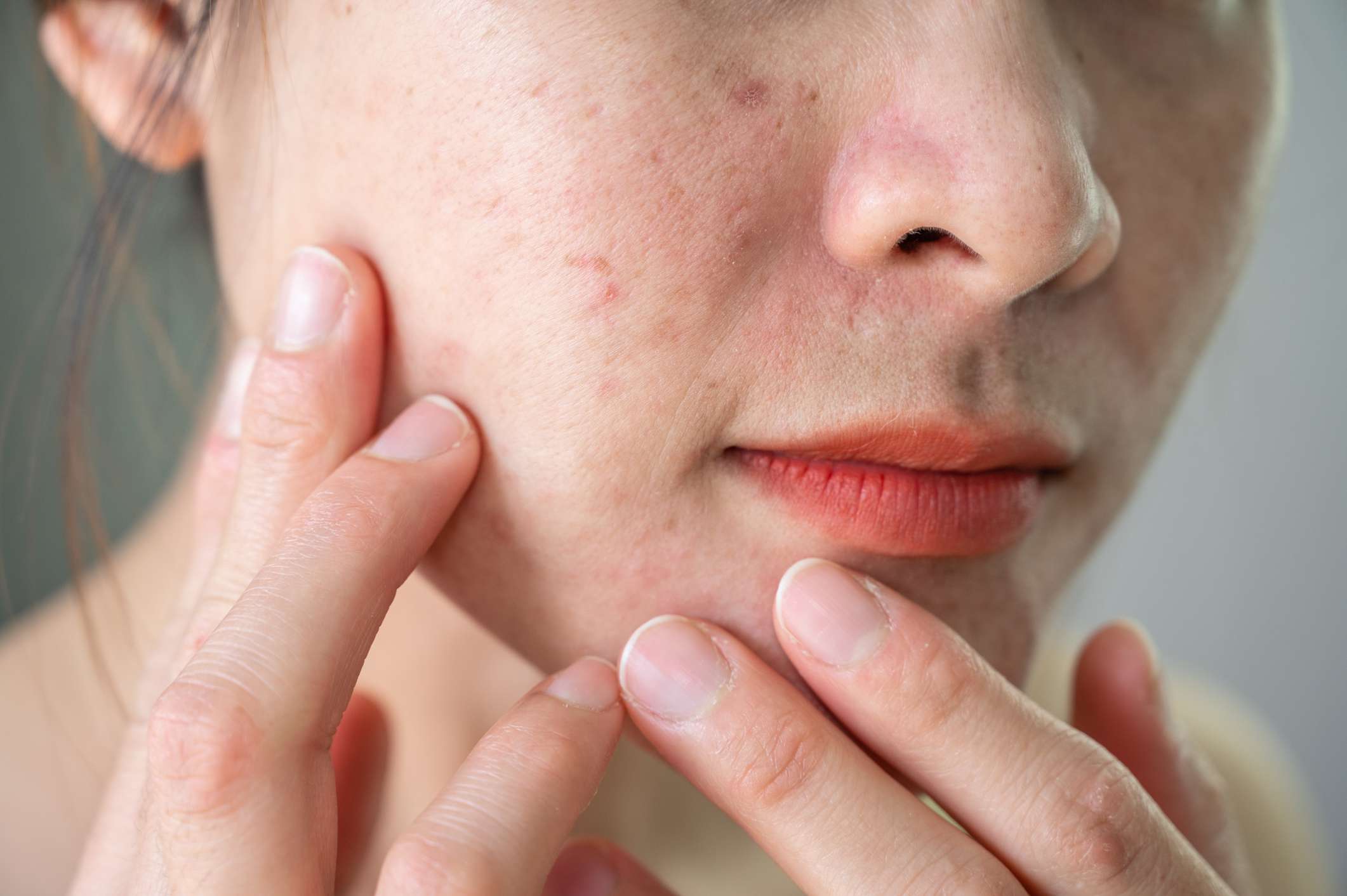 Does Pimples Treatment Improve Skin Texture