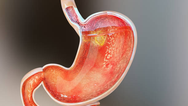 Gastric Balloon in Riyadh