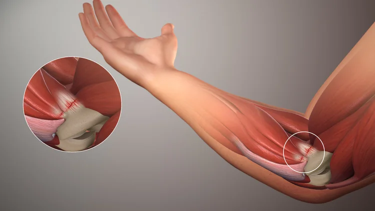 Restore Strength After Golfer’s Elbow With Edinburgh Physio