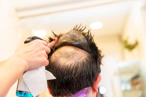Hair Transplant in Riyadh