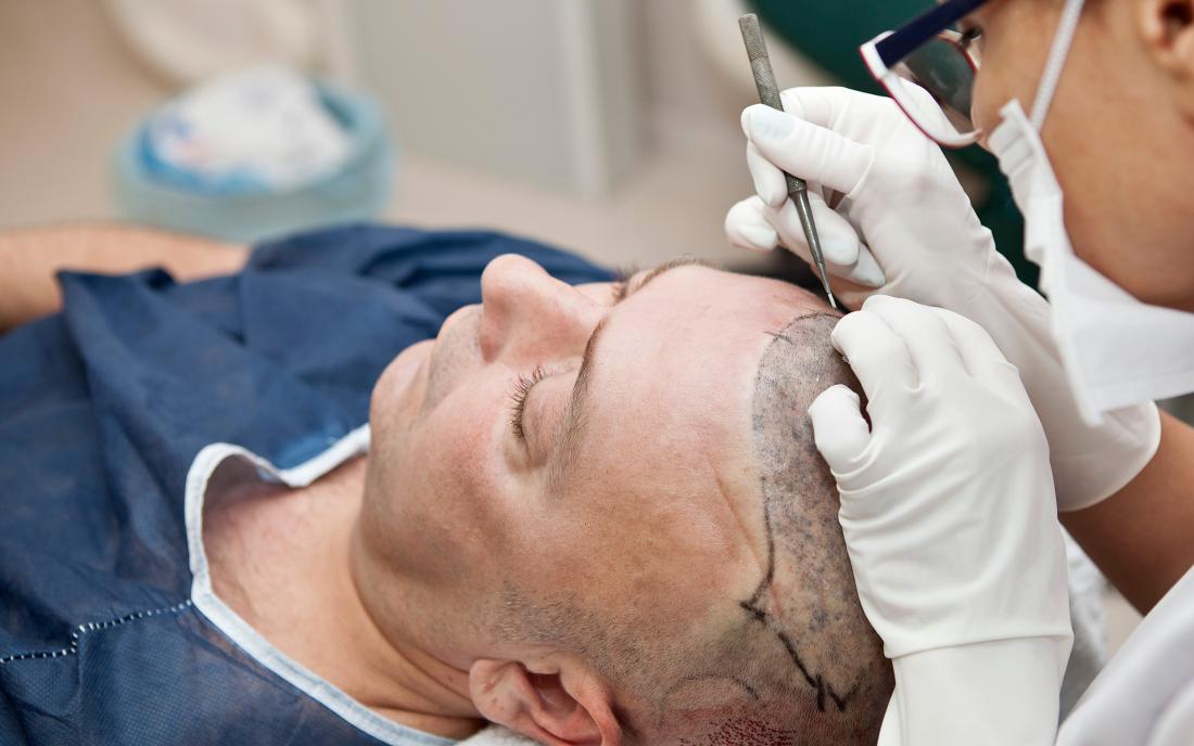Hair Transplant in Dubai Is Confidence on Demand