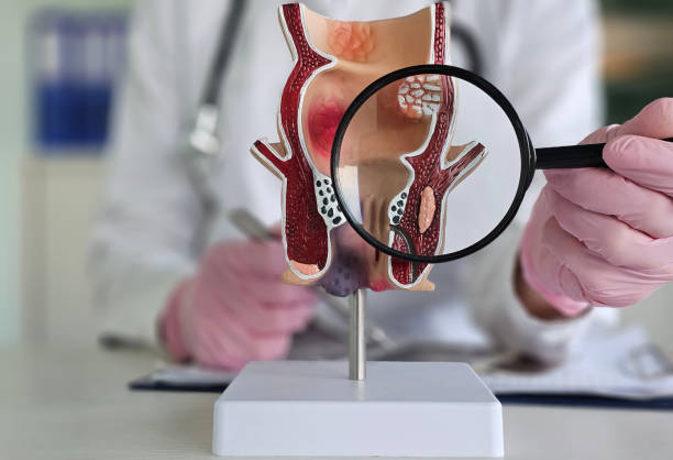 Private Hemorrhoid Care in Riyadh