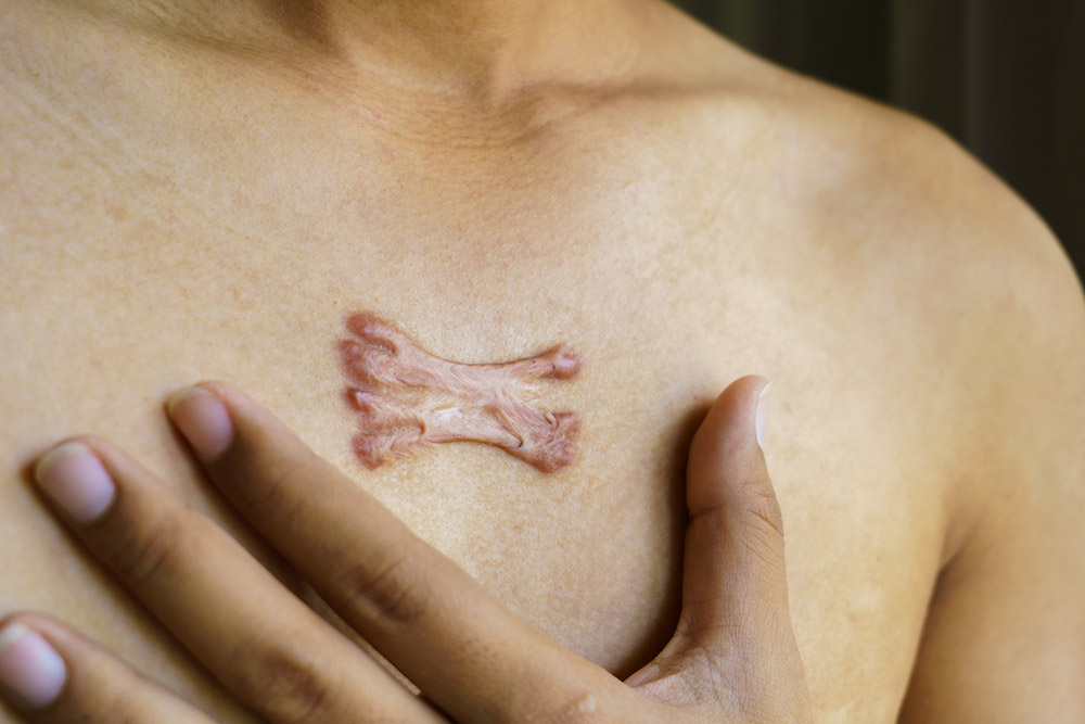Is Keloid Treatment Safe for All Skin Types
