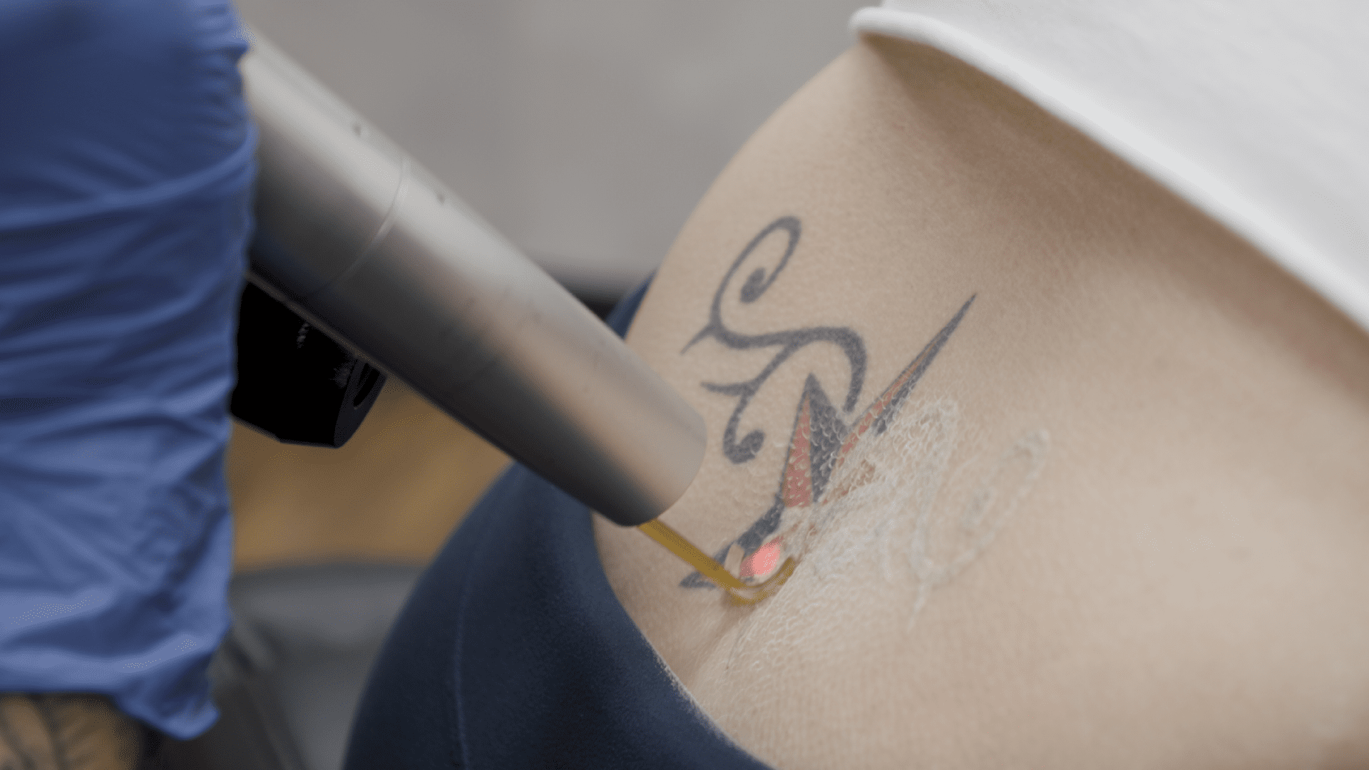 Pico Laser Tattoo Removal Dubai,Pico Laser Tattoo Removal,Best Pico Laser Tattoo Removal Dubai